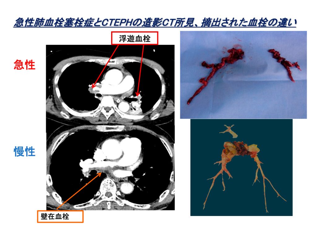 急性肺血栓塞栓症とCTEPHの造影CT所見、摘出された血栓の違い