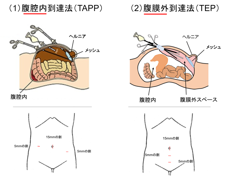 TEP法の利点