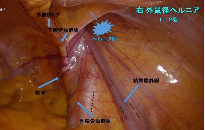 腹腔内アプローチによる腹腔鏡下ヘルニア修復術