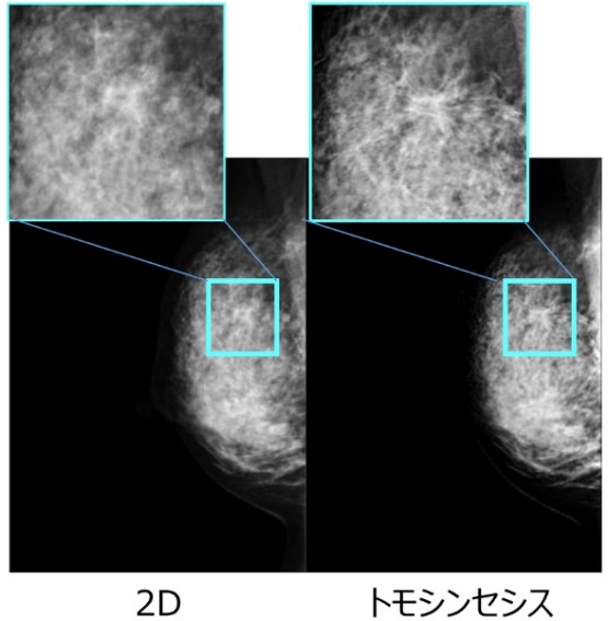 3Dマンモグラフィ