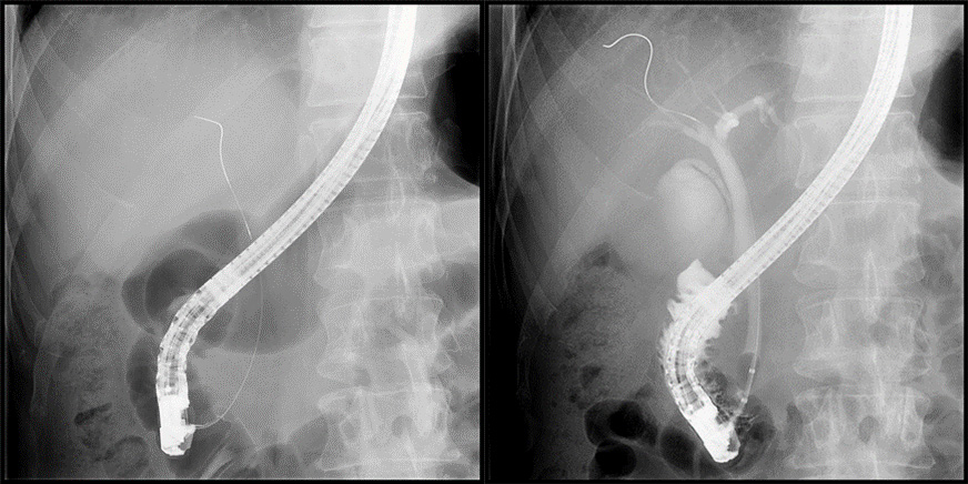 ERCP(内視鏡的逆行性胆管膵管造影)