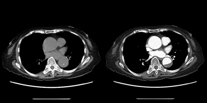 単純CT検査と造影CT検査