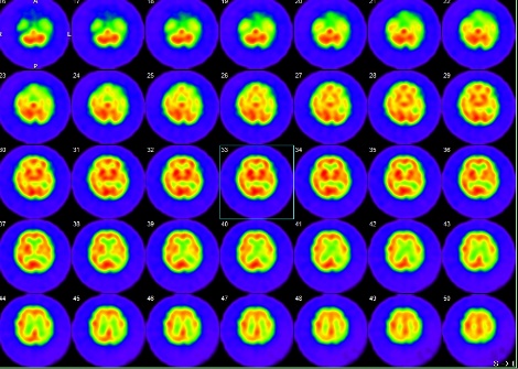 脳血流シンチグラフィ