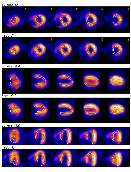 心筋血流シンチグラフィ